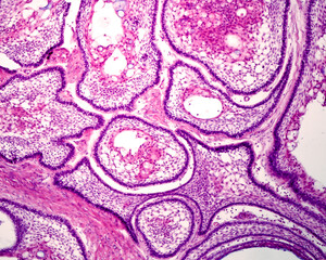 Human maxillary. Ameloblastoma