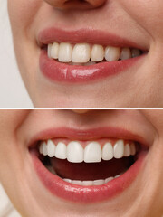 Fototapeta premium Woman smiling before and after procedure dental veneers placement, closeup. Aesthetic improvement of teeth, collage