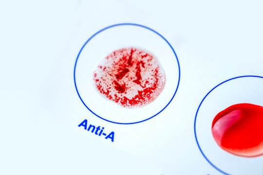 Blood typing test card with Anti-A result, diagnostics and health awareness, personal health and awareness, self-care monitoring, self-testing for diet, agglutination process