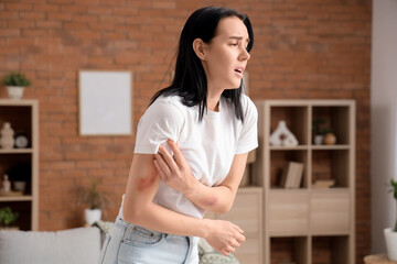 Beautiful young worried woman with bruised arms at home