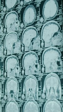 No people vertical closeup of patient brain tomography results on film viewed on light box in hospital, with multiple axial, sagittal, coronal planes to detect tumor or aneurism