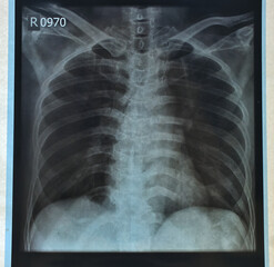x-ray results rib on the human body