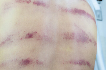 Close-up of skin showing lines of bruising and redness, indicative of a medical treatment or physical injury. Highlights the texture and discoloration.