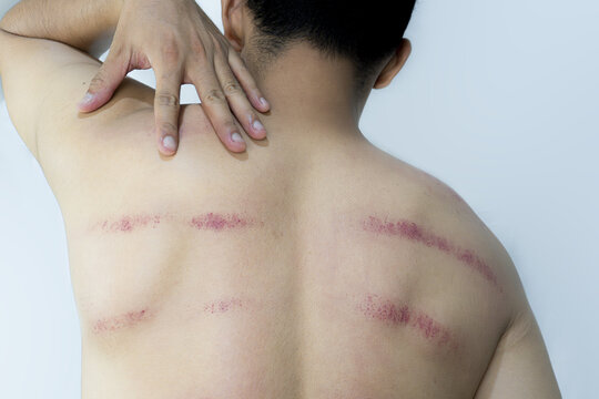 Man showing his back with visible bruising and redness, touching his shoulder. Illustrates a health condition or physical therapy outcome.