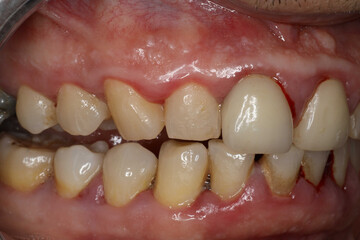 Inflamed bleeding gums, sore gums, gum infection, mouth concept, health.