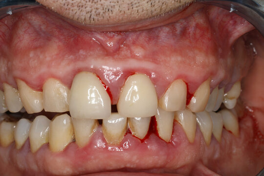 Inflamed bleeding gums, sore gums, gum infection, mouth concept, health.