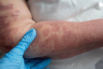 Capillary malformation on the female hand. Medicine, health, genetics, medical examination concept.