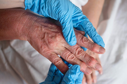 Arthritis of the fingers and capillary malformation on the female hand when examined by a doctor. Medicine, health, genetics, medical examination concept.