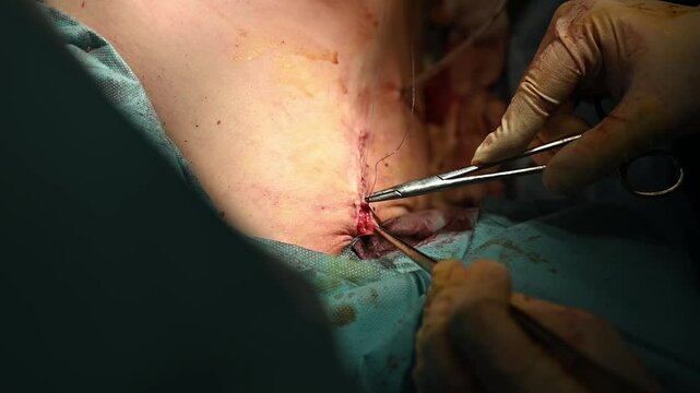 An InDepth Detailed View of the Complete Surgical Procedure Involving Incision and Stitching