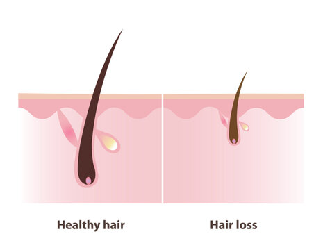 The difference between of hair follicle healthy hair and hair loss with scalp layer illustration. The hair follicle miniaturization leads to the production of thinner, shorter, weaker hair strands.
