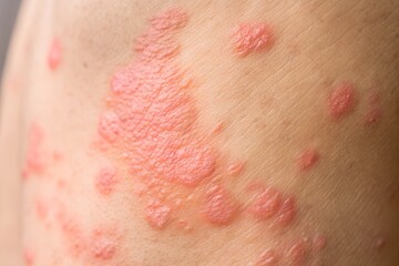 Close-up of red skin rash with blisters - A detailed close-up of an inflamed red skin rash with blisters, possibly caused by shingles, herpes, or an allergic reaction.  