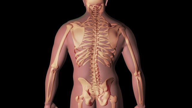 Biomedical illustration showing scoliosis in the human spine.