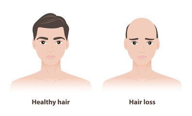 Obraz premium Comparison of two men with healthy hair and hair loss vector illustration on white background. The man with thick and strong hair, the other with thinner hair to baldness, androgenetic alopecia.
