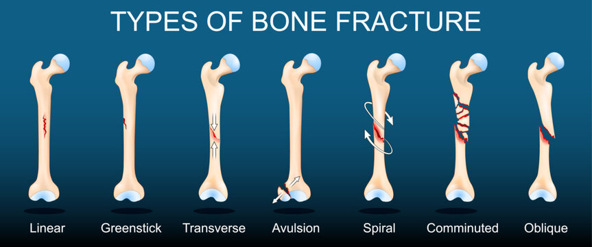 Broken Human femurs on dark background.
