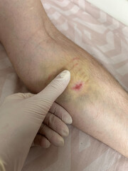 A medical professional examines a minor injury on the arm of a patient. The area shows signs of...