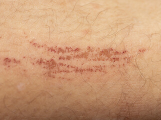scratches on the skin of the leg as a background.