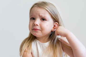 Scared and sad little girl child with viral rash from chickenpox lying in bed. Chickenpox disease,...