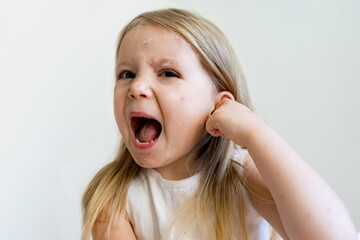 Scared and sad little girl child with viral rash from chickenpox lying in bed. Chickenpox disease, smeared with antiseptic. Children's diseases.