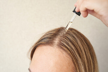 Caucasian female applying hair serum with dropper for scalp care treatment and hair health improvement.
