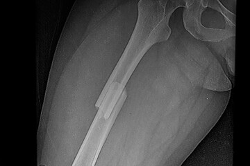 Medical themes: X Ray image of fracture in the middle third of the transverse complete femur.