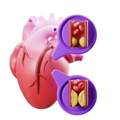 Coronary artery disease. 3d illustration