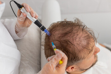 Alopecia. Man hair loss improve growth treatment regeneration, dermapen microneedling vitamin...