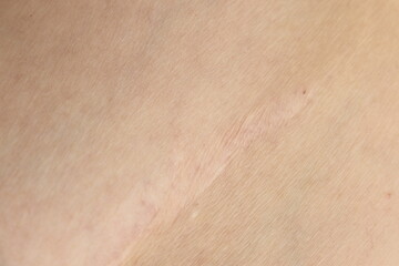 A close-up of a large scar on a skin. Dermatology and skin. Medecine and scar treatment.