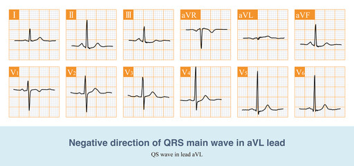 When the whole ventricular excitation potential faces downward and exceeds+60, the QRS wave projection is negative in aVL lead.
