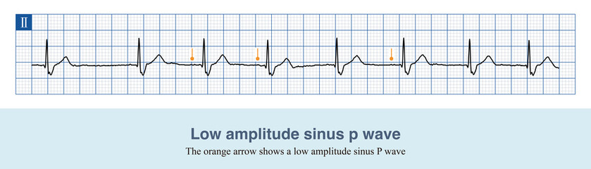 Sometimes, the amplitude of sinus P wave is extremely low, close to equipotential line, and it is easy to be misdiagnosed as junctional rhythm. 
