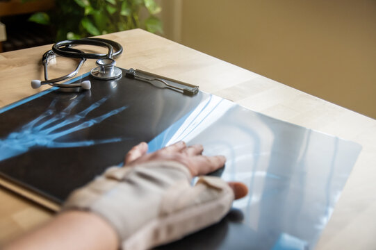 Doctor is examining a hand x-ray on a wooden desk with a stethoscope nearby, suggesting a diagnosis related to a work accident, traumatology, or sick leave