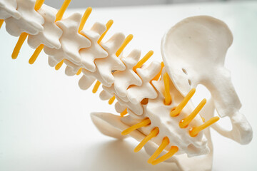 Spinal nerve and bone, Lumbar spine displaced herniated disc fragment, Model for treatment medical...