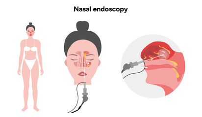 Nasal endoscopy procedure nasal and sinus passages. Thin, flexible tube with camera and light. Ear, nose, and throat. Medical diagram