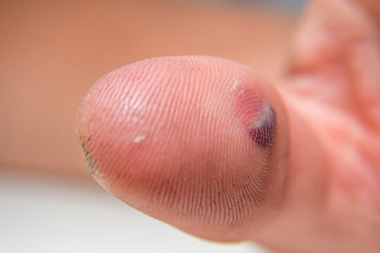 Blood blister under the thumb skin. Caucasian young man finger on white background