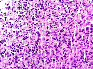 Mixed cellularity classic Hodgkin lymphoma (MCCHL), a subtype of classic Hodgkin lymphoma characterized by Hodgkin, Reed Sternberg cells in a diffuse mixed inflammatory background