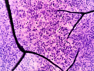 Mixed cellularity classic Hodgkin lymphoma (MCCHL), a subtype of classic Hodgkin lymphoma characterized by Hodgkin, Reed Sternberg cells in a diffuse mixed inflammatory background