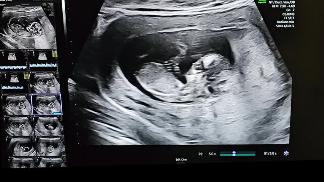 Ultrasound images of imbreon's baby display fetal development and movements inside the womb, providing a glimpse into the fascinating journey of pregnancy