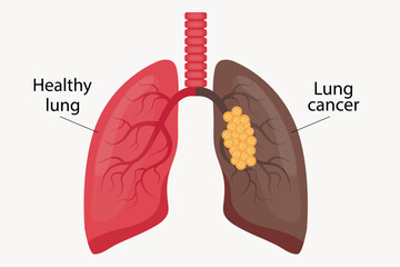 Illustration of healthy lung and lung cancer.