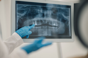 Dentist pointing at teeth x ray on computer screen discussing diagnosis