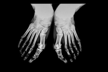 Standard radiograph of both feet in a weight-bearing position, showing the anatomical structure of...