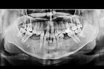 Dental panoramic x-ray of a patient biting teeth showing missing lower premolars, a decayed upper molar, and fractured central incisors with a visible fracture line on the crown due to facial trauma.