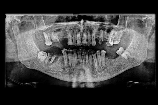Dental panoramic x-ray revealing multiple cavities, missing teeth, an upper molar with a completed root canal treatment, and an advanced periodontal bone loss affecting an infected lower molar