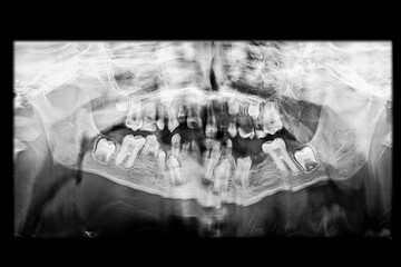 Low-quality dental panoramic x-ray due to movement during the image acquisition of a young patient showing missing teeth, misaligned primary teeth, and permanent teeth included in the alveolar bone