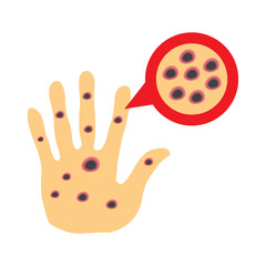 Monkeypox virus on skin 