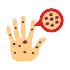 Monkeypox virus on skin 