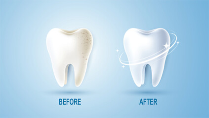 Set of dental cleaning and whitening teeth concept. comparison of clean and dirty tooth. dental health and oral hygiene poster for dentistry. examination teeth, whitening and repair. vector design.
