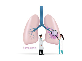 Doctors studying sarcoidosis granuloma in human lungs illustration