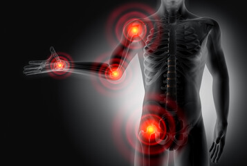 X ray style 3D Rendering - Severe pain in the joints - Rheumatism and arthrosis