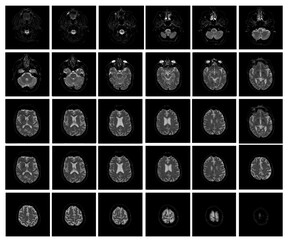 1 of the 12 Magnetic Resonance images series of a 67yo man.  MRI brain and brainstem: axial, coronal, and sagittal plane imaging with T1, T2, FLAIR, DWI, T2* sequences. Other images in the portfolio.