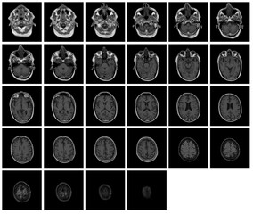 1 of the 12 Magnetic Resonance images series of a 67yo man.  MRI brain and brainstem: axial, coronal, and sagittal plane imaging with T1, T2, FLAIR, DWI, T2* sequences. Other images in the portfolio.