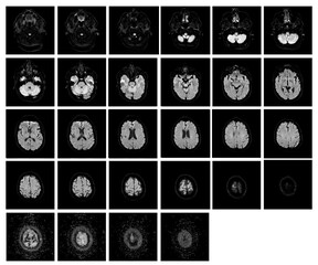 1 of the 12 Magnetic Resonance images series of a 67yo man.  MRI brain and brainstem: axial, coronal, and sagittal plane imaging with T1, T2, FLAIR, DWI, T2* sequences. Other images in the portfolio.